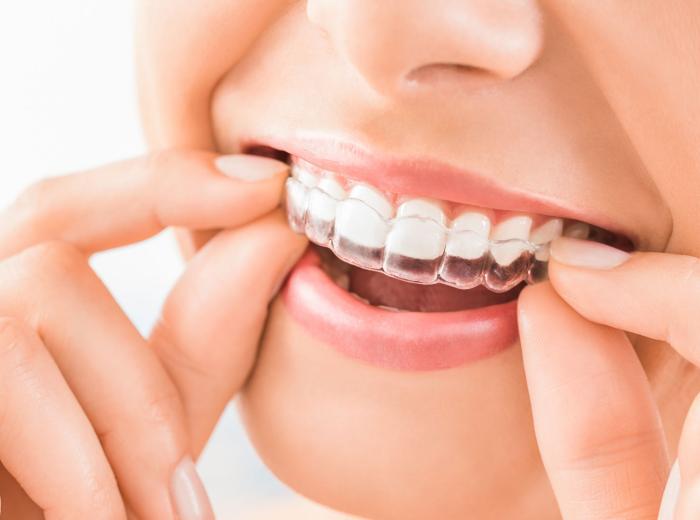 Read this if you're considering online clear aligners or other online dental products!
